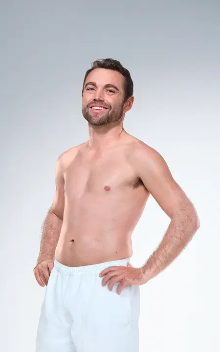 Caucasian male's CoolSculpting results
