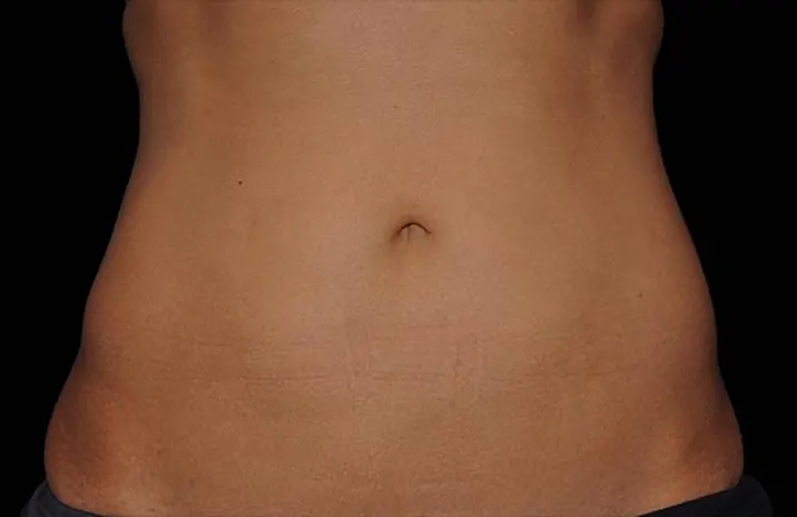 Before and after images of CoolSculpting female model's abdomen