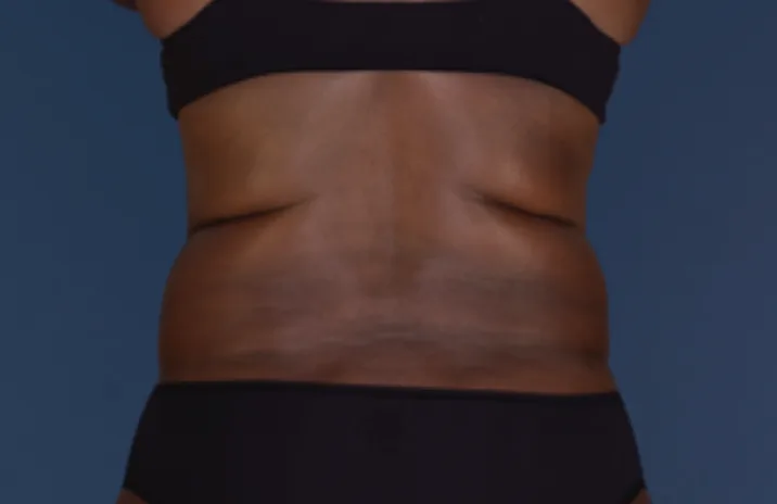 Before and after images of CoolSculpting female model's back fat/bra fat