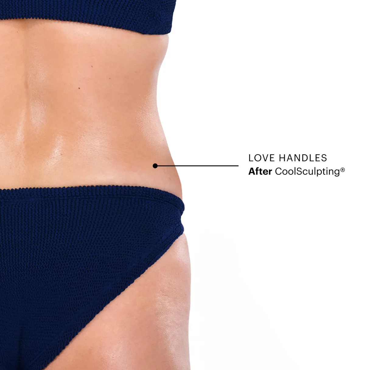 Zoomed-in image of CoolSculpting model's love handles after the treatment