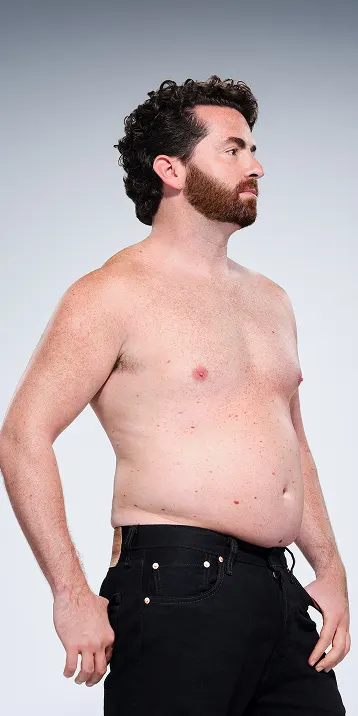 CoolSculpting male model before & after CoolSculpting