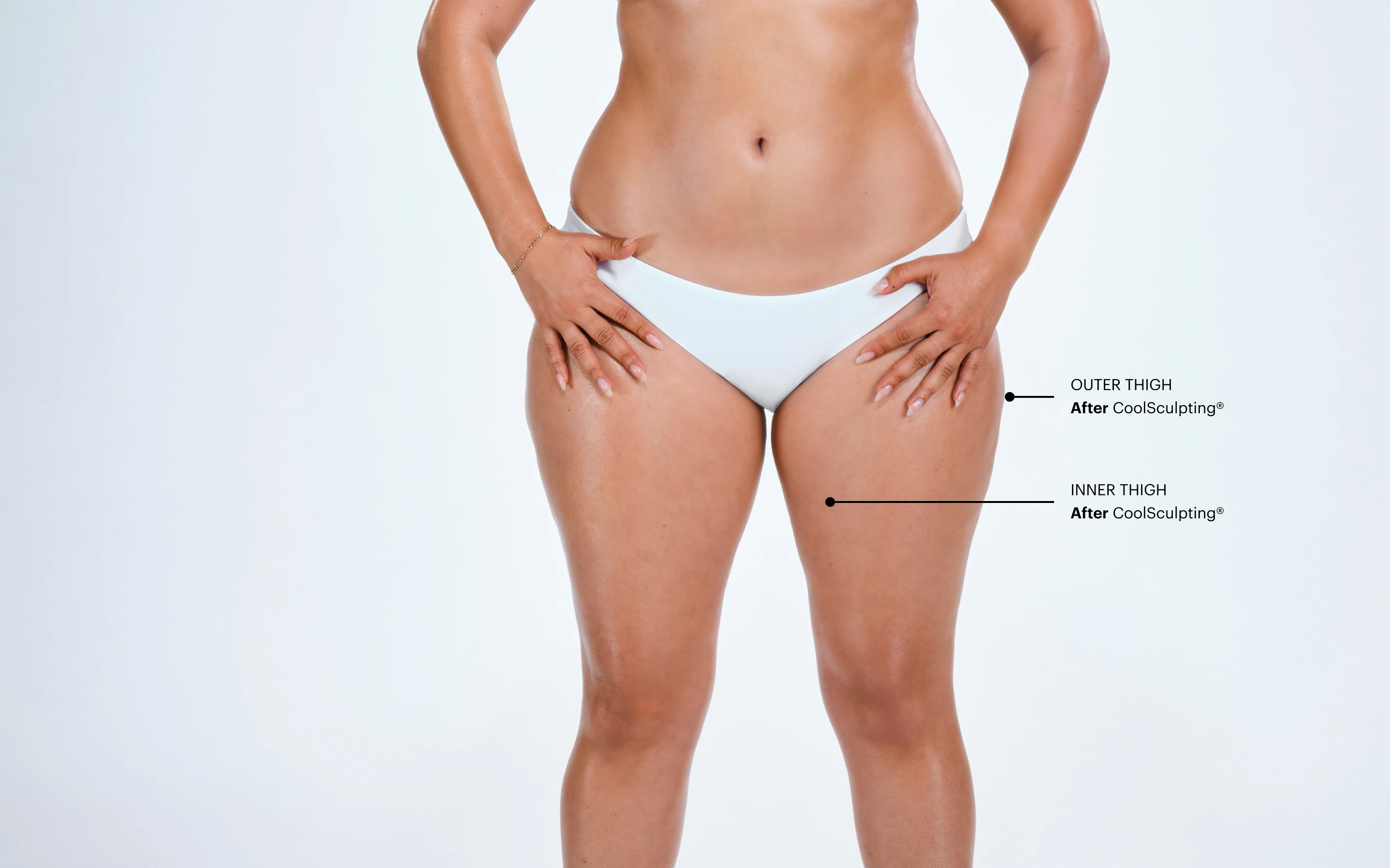 Zoomed-in image of CoolSculpting model's thighs before the treatment 