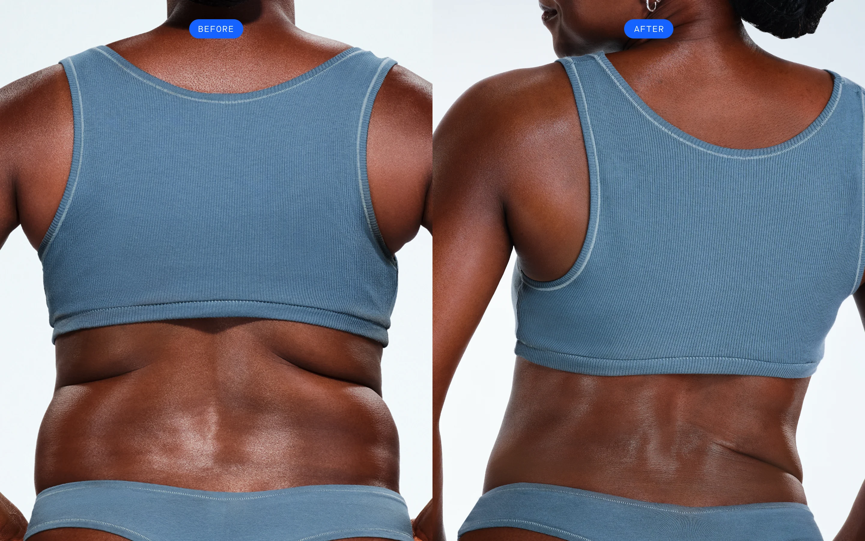 CoolSculpting before & after of model's back