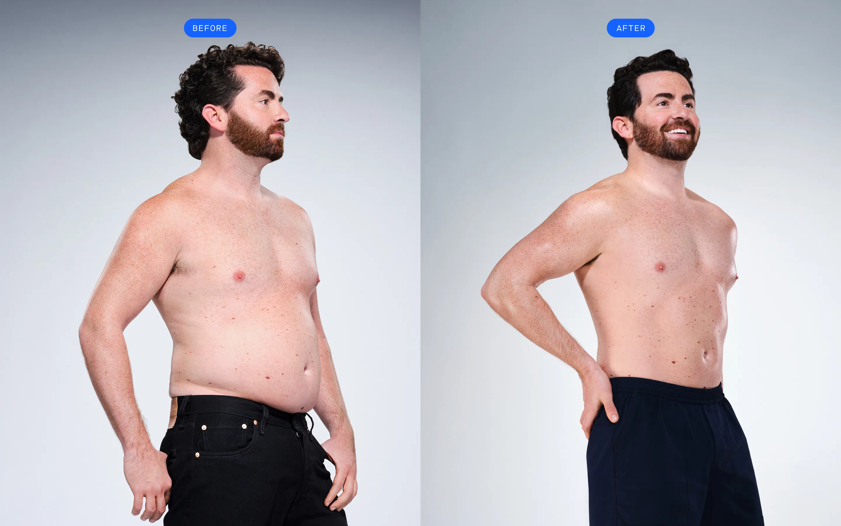 CoolSculpting male model before & after CoolSculpting