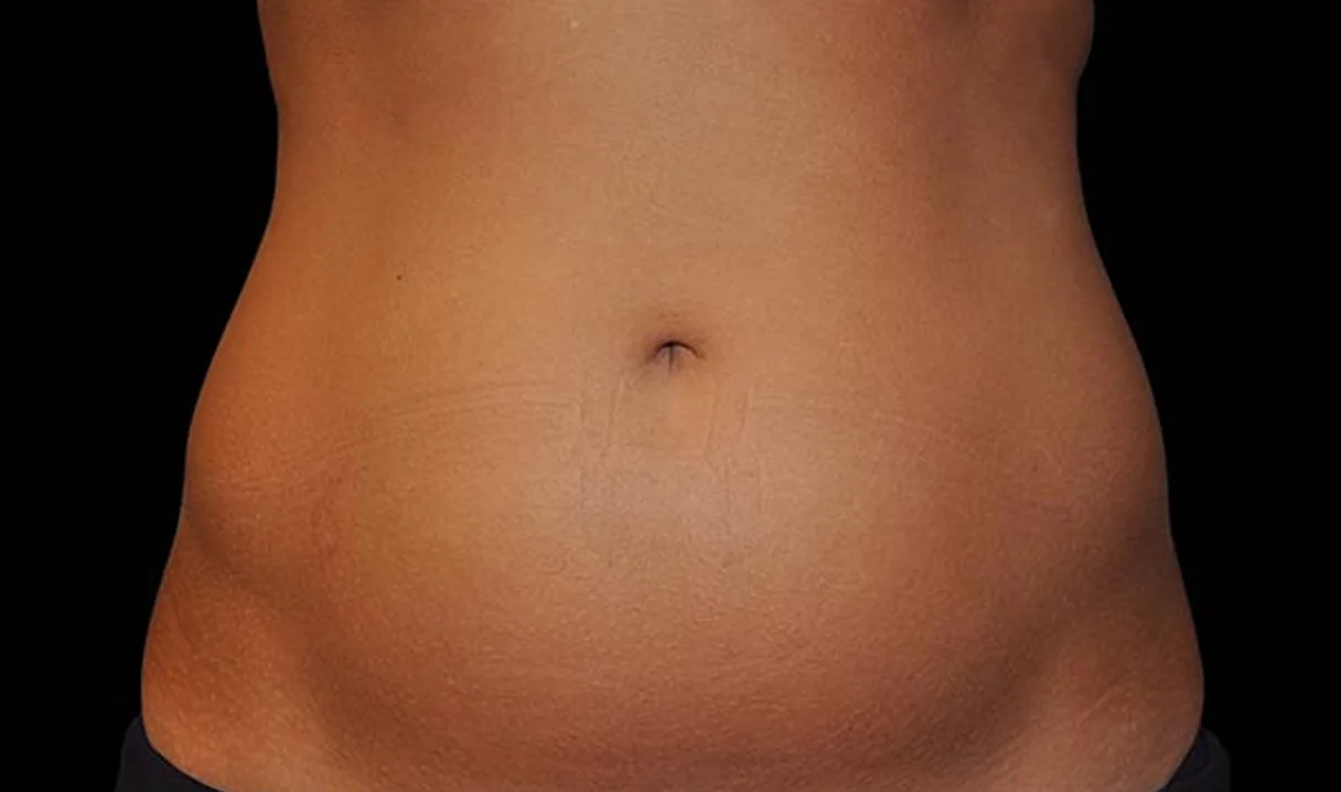 Before and after images of CoolSculpting female model's abdomen