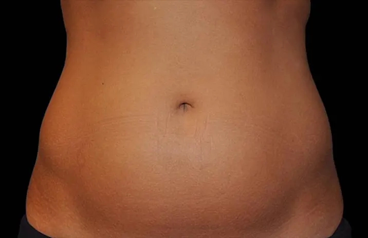 Before and after images of CoolSculpting female model's abdomen