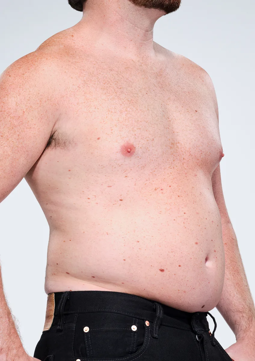 Before and after images of CoolSculpting male model's abdomen