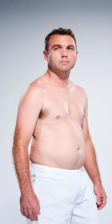 CoolSculpting male model before & after CoolSculpting