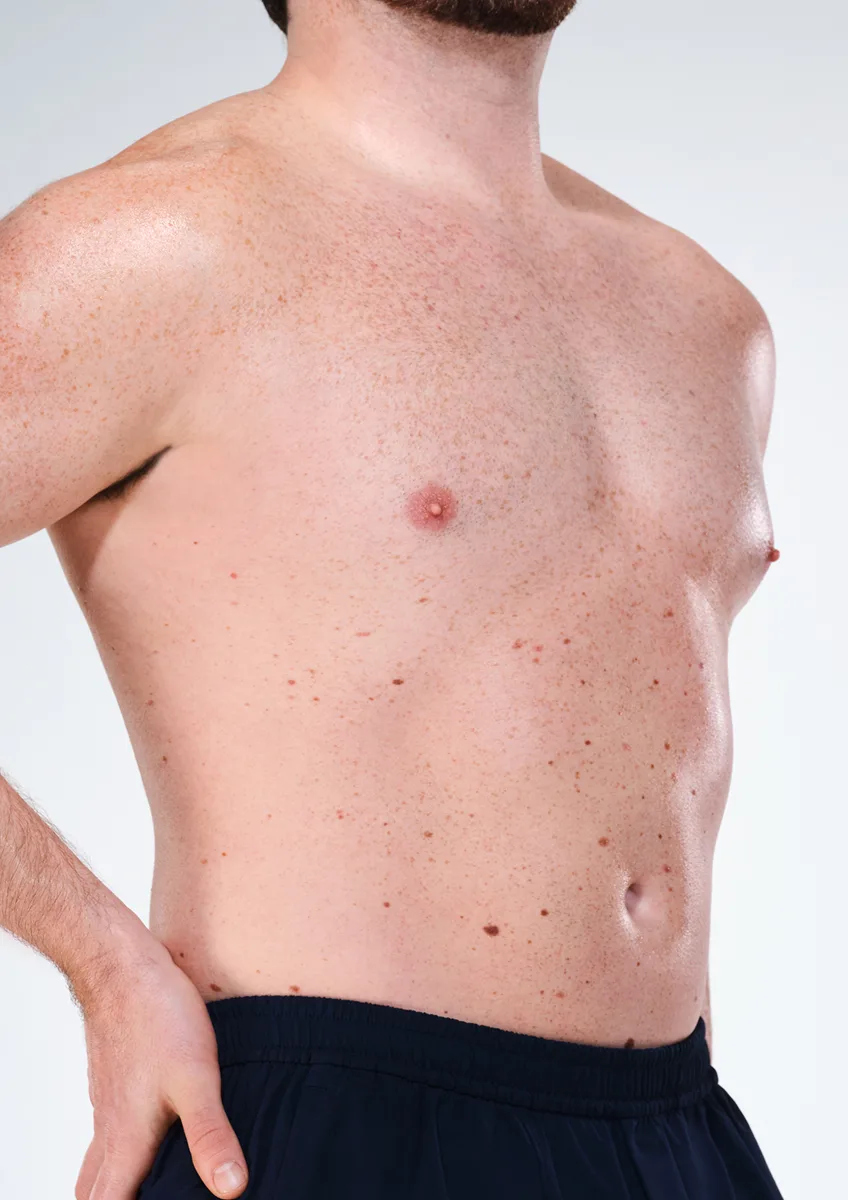 Before and after images of CoolSculpting male model's abdomen