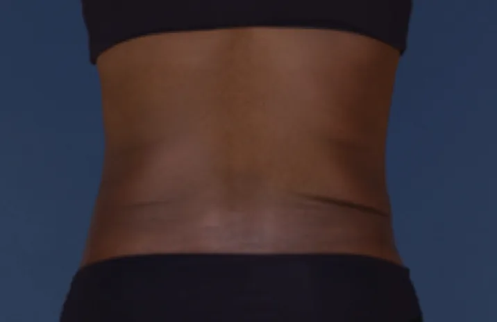 Before and after images of CoolSculpting female model's back fat/bra fat