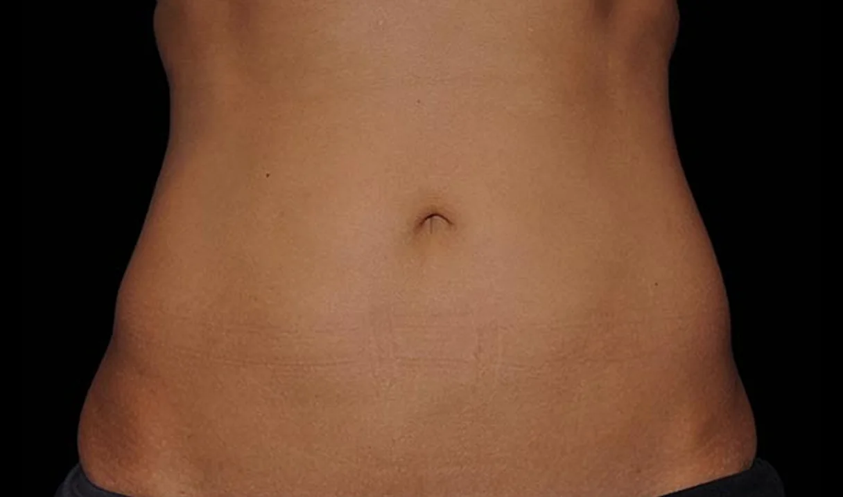 Before and after images of CoolSculpting female model's abdomen
