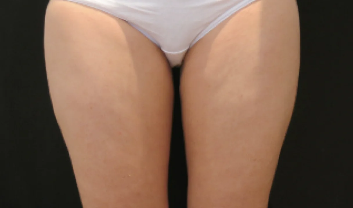 Before and after images of CoolSculpting female model's thighs