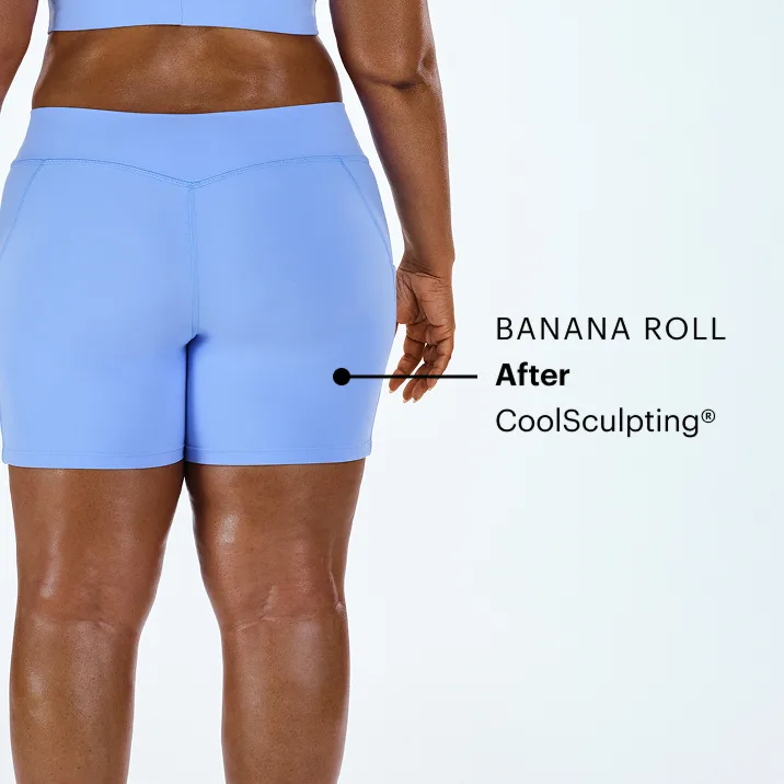 Zoomed-in image of CoolSculpting model's banana roll after the treatment 
