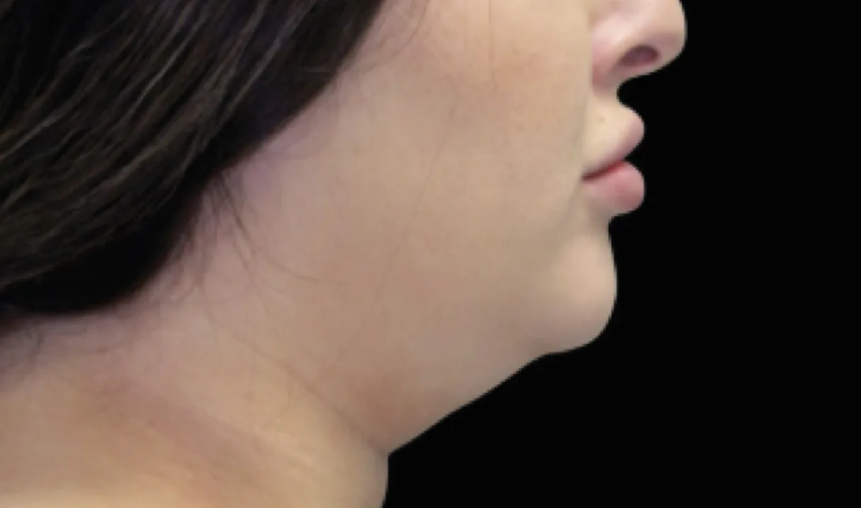 Before and after images of CoolSculpting female model's chin
