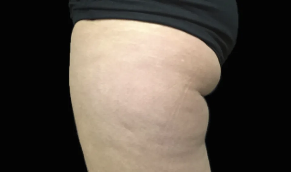 Before and after images of CoolSculpting female model's banana roll