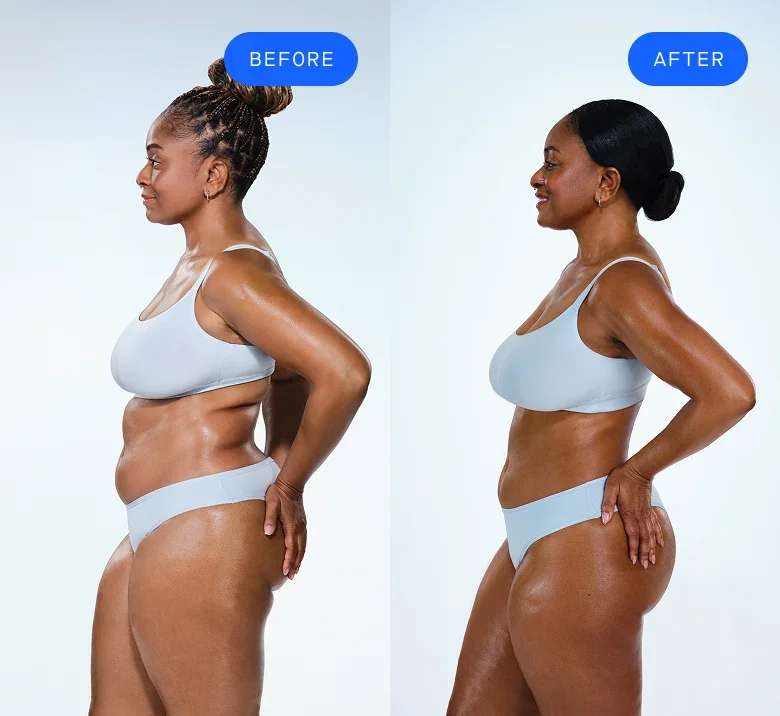CoolSculpting female model before & after CoolSculpting