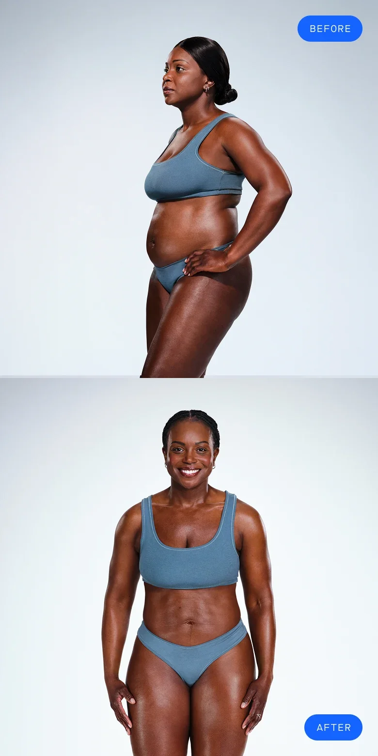 CoolSculpting before & after of model's back