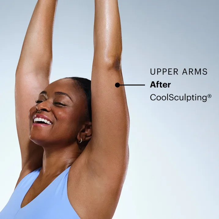 CoolSculpting model's arms after the treatment 