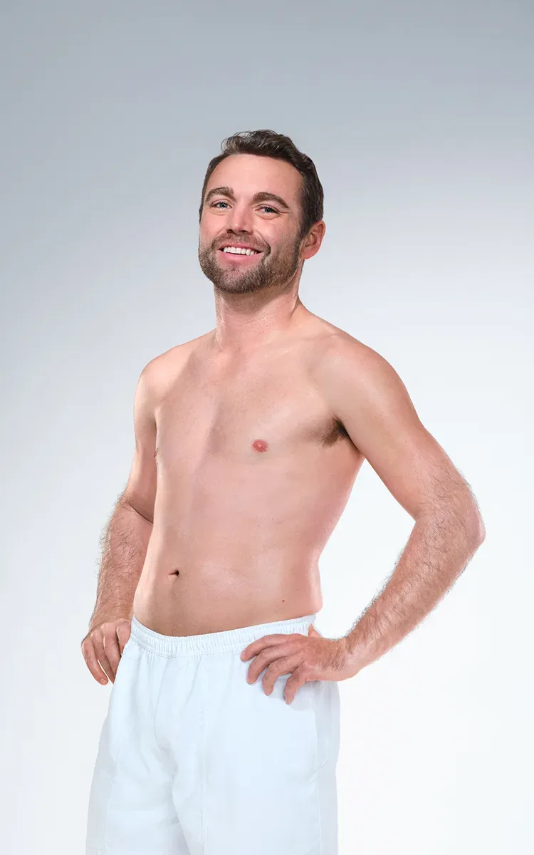 Caucasian male's CoolSculpting results