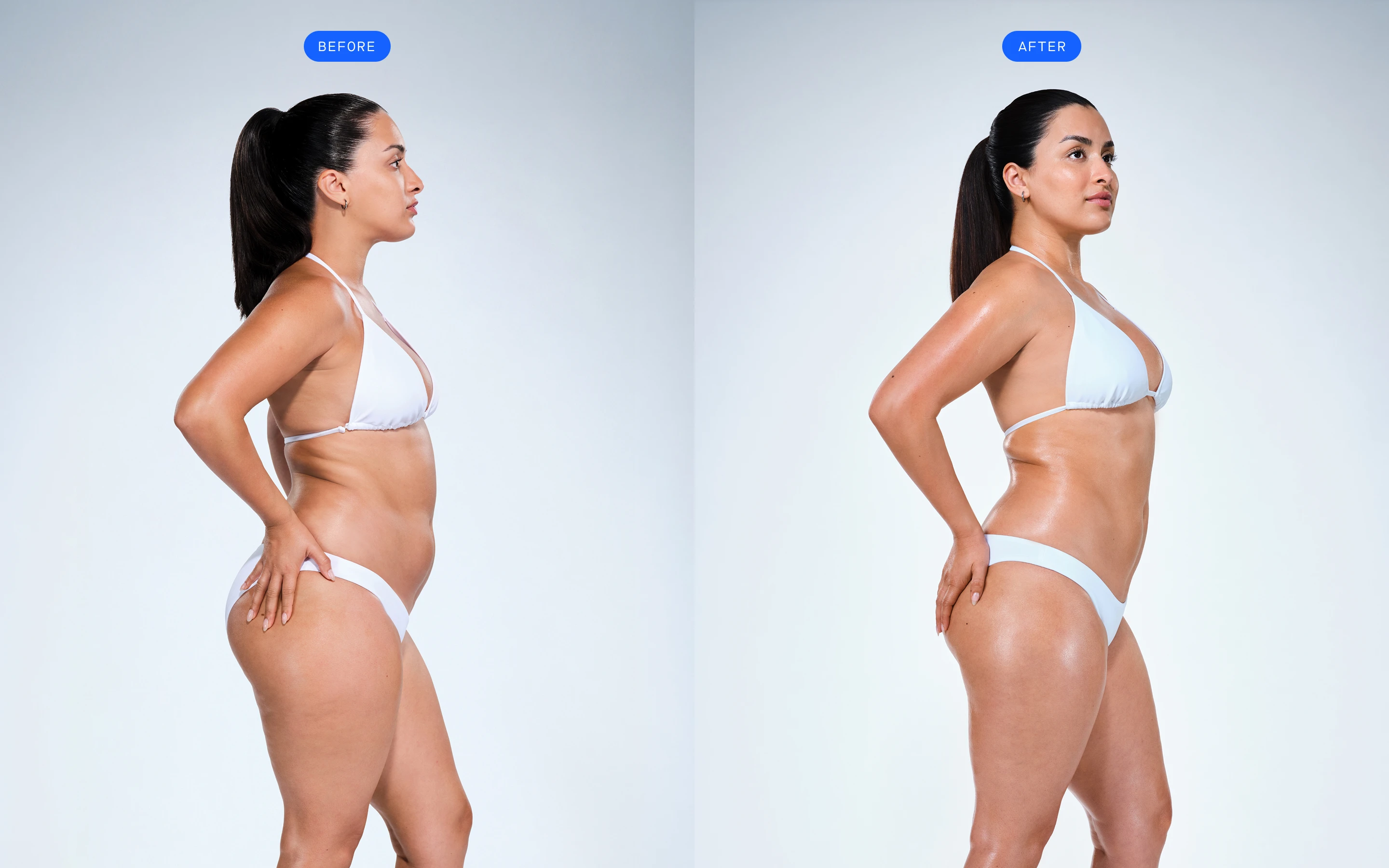 CoolSculpting female model before & after CoolSculpting
