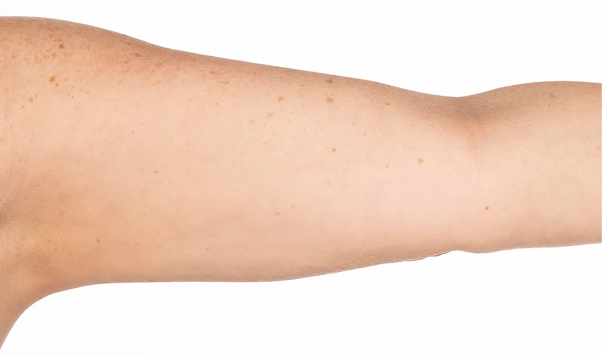 Before and after images of CoolSculpting female model's arms