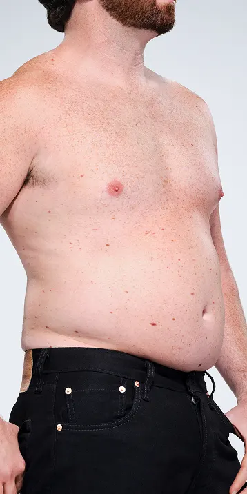 Before and after images of CoolSculpting male model's abdomen