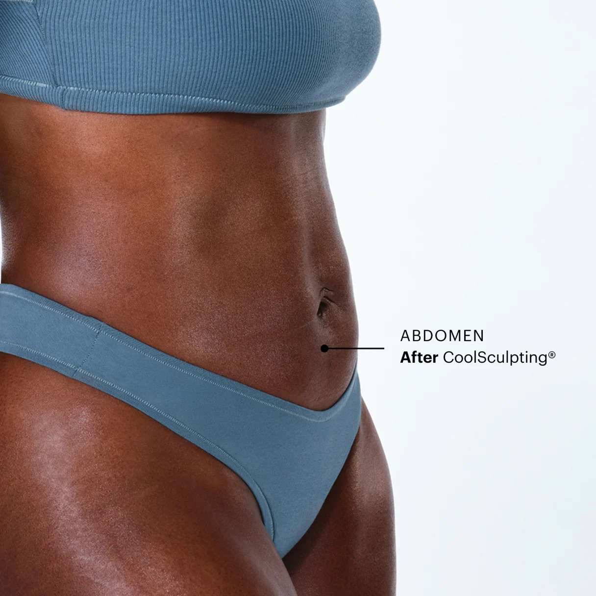 Zoomed-in image of CoolSculpting model's abdomen after the treatment 