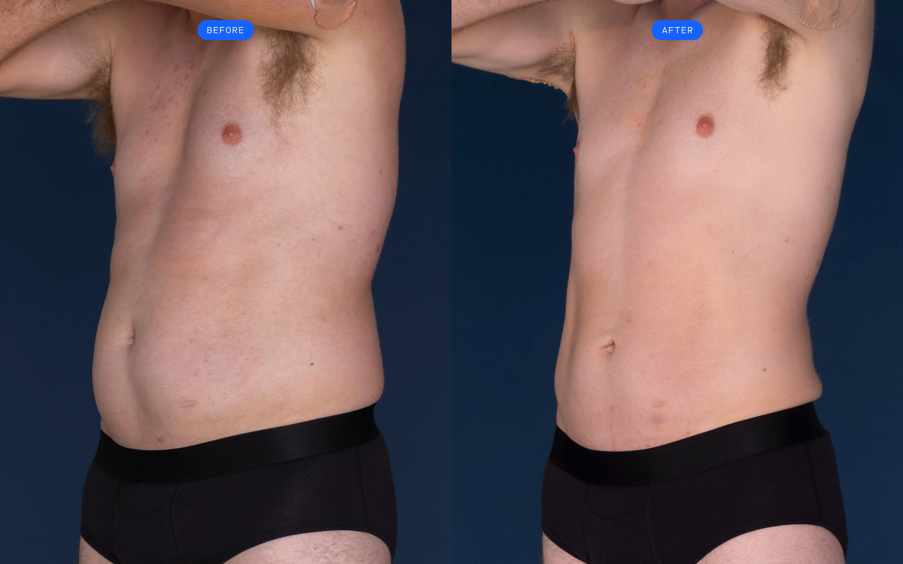 CoolSculpting before & after of model's abdomen
