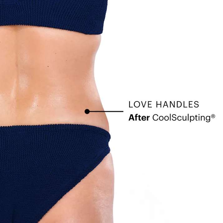 Zoomed-in image of CoolSculpting model's love handles after the treatment 
