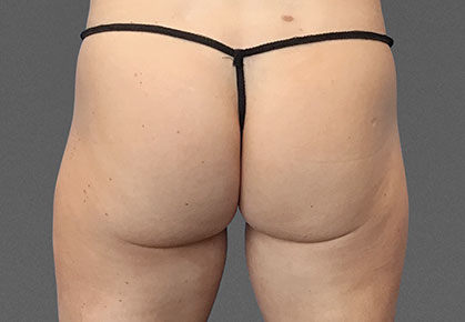 Female Buttocks Before CoolTone