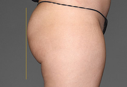 Female Buttocks After CoolTone