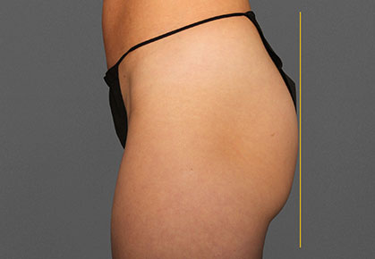 Female Buttocks Before CoolTone