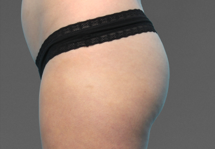 Female Buttocks After CoolTone